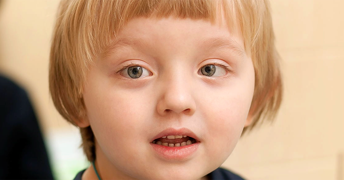 Strabismus