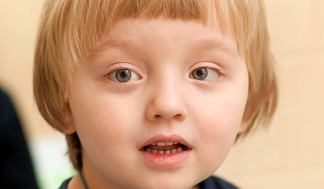 What to Know About Strabismus
