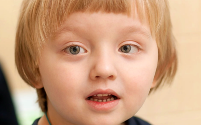 What to Know About Strabismus